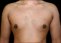 Gynecomastia Before & After Patient #647