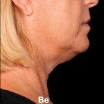 Kybella Before & After Patient #1212
