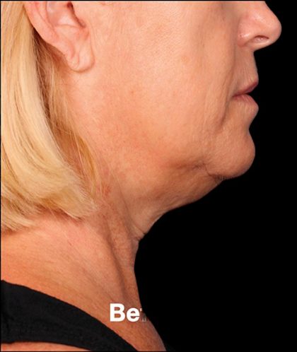 Kybella Before & After Patient #1212