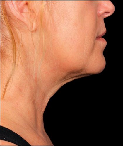 Kybella Before & After Patient #1212