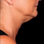 Kybella Before & After Patient #1213