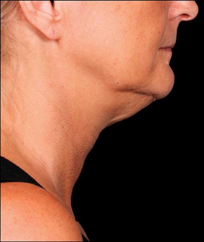 Kybella Before & After Patient #1213