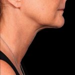 Kybella Before & After Patient #1213