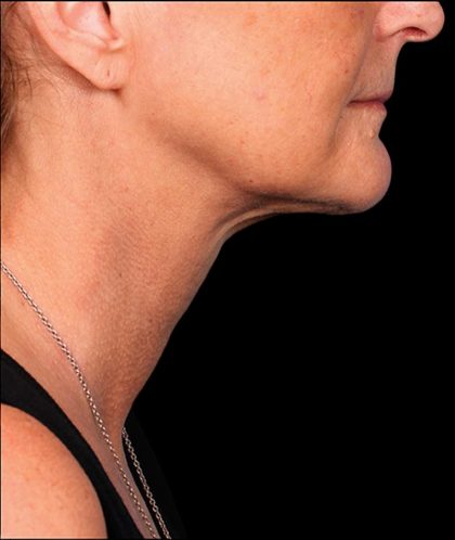 Kybella Before & After Patient #1213