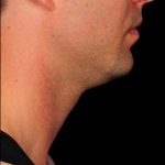 Kybella Before & After Patient #1214
