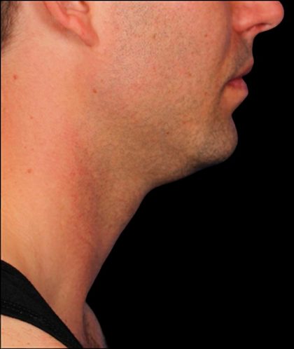Kybella Before & After Patient #1214