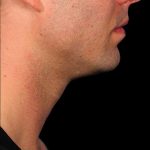 Kybella Before & After Patient #1214