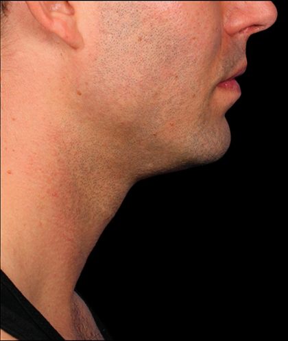 Kybella Before & After Patient #1214