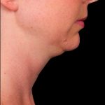 Kybella Before & After Patient #1215