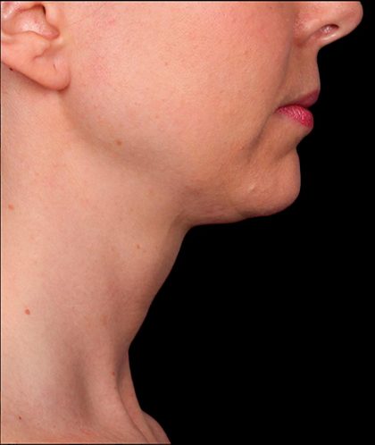 Kybella Before & After Patient #1215