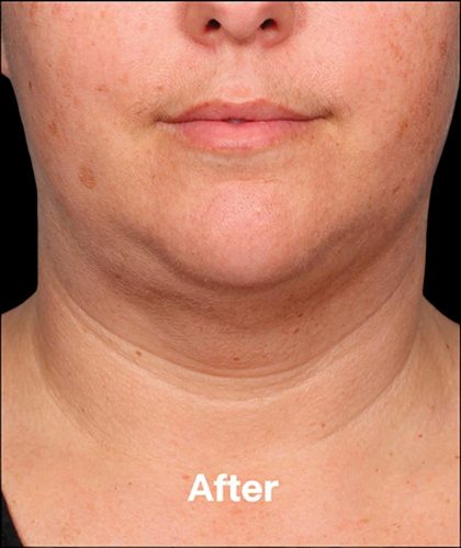 Kybella Before & After Patient #1216