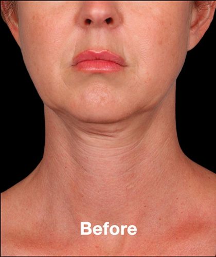 Kybella Before & After Patient #1217