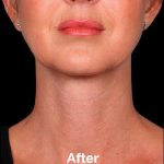 Kybella Before & After Patient #1217