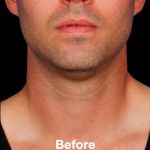 Kybella Before & After Patient #1218