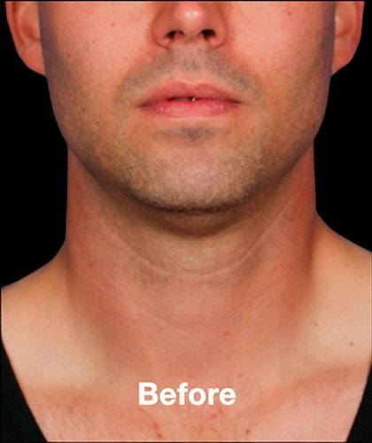 Kybella Before & After Patient #1218