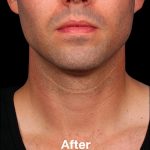 Kybella Before & After Patient #1218