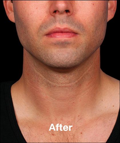 Kybella Before & After Patient #1218