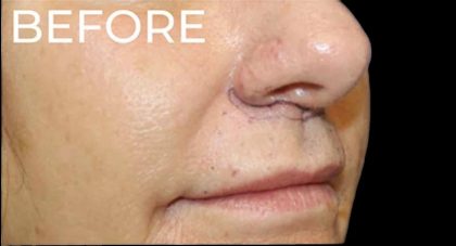 Lip Lift Before & After Patient #956