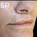 Lip Lift Before & After Patient #956