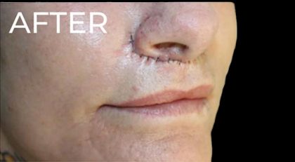 Lip Lift Before & After Patient #956