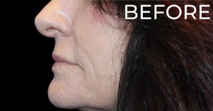 Lip Lift Before & After Patient #956