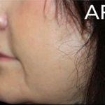 Lip Lift Before & After Patient #956
