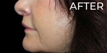 Lip Lift Before & After Patient #956