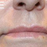 Lip Lift Before & After Patient #956