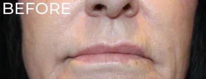 Lip Lift Before & After Patient #956