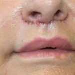 Lip Lift Before & After Patient #956