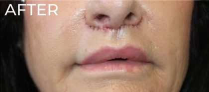 Lip Lift Before & After Patient #956