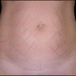 Liposuction Abdomen Before & After Patient #855
