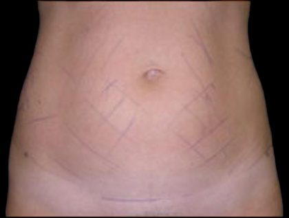 Liposuction Abdomen Before & After Patient #855