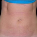 Liposuction Abdomen Before & After Patient #855