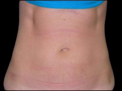 Liposuction Abdomen Before & After Patient #855