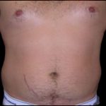 Liposuction Abdomen Before & After Patient #859