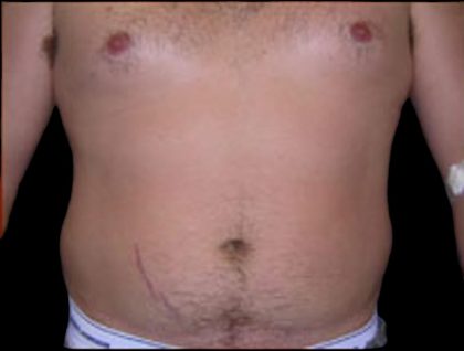 Liposuction Abdomen Before & After Patient #859