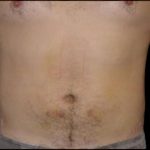 Liposuction Abdomen Before & After Patient #859