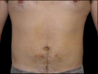 Liposuction Abdomen Before & After Patient #859