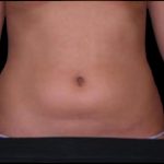 Liposuction Abdomen Before & After Patient #863