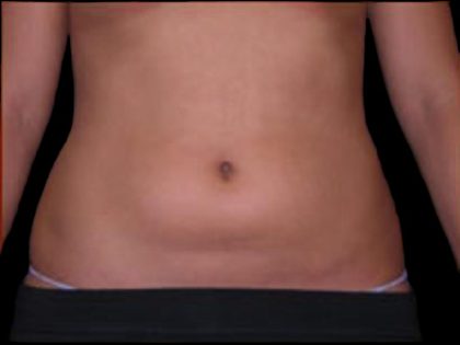 Liposuction Abdomen Before & After Patient #863