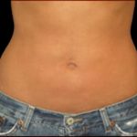 Liposuction Abdomen Before & After Patient #863