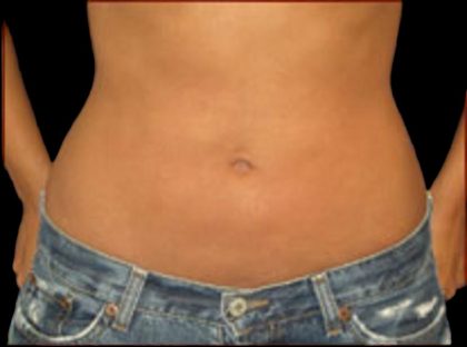 Liposuction Abdomen Before & After Patient #863