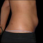 Liposuction Abdomen Before & After Patient #863