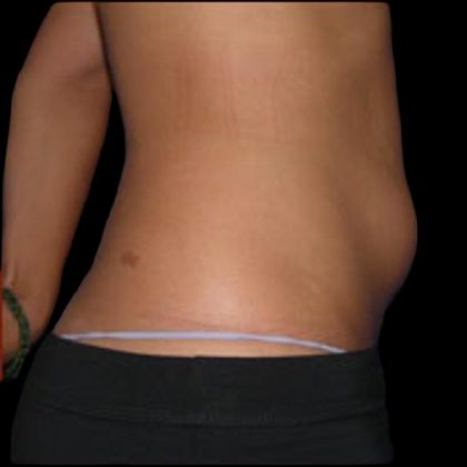 Liposuction Abdomen Before & After Patient #863