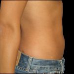Liposuction Abdomen Before & After Patient #863