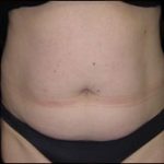 Liposuction Abdomen Before & After Patient #865