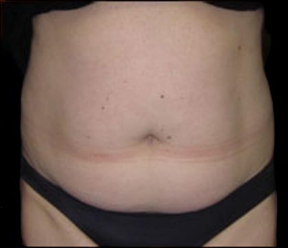 Liposuction Abdomen Before & After Patient #865