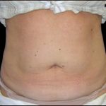 Liposuction Abdomen Before & After Patient #865