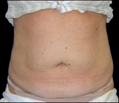 Liposuction Abdomen Before & After Patient #865